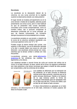 Radovan Sancevic - La escoliosis es una desviación de la columna, es una  curva en forma de 'S' y en la dirección equivocada. El 3% de la población  padece una anomalía de