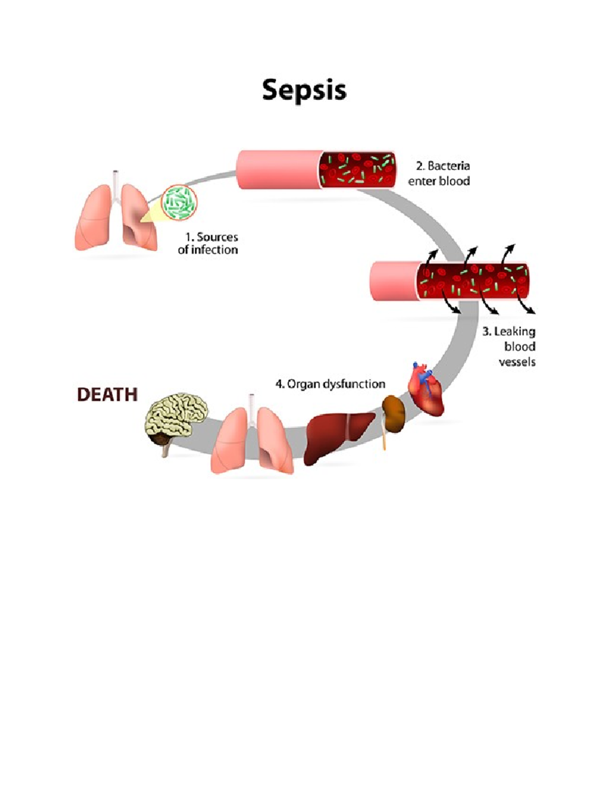Sepsis - NURS3515-100 - Studocu