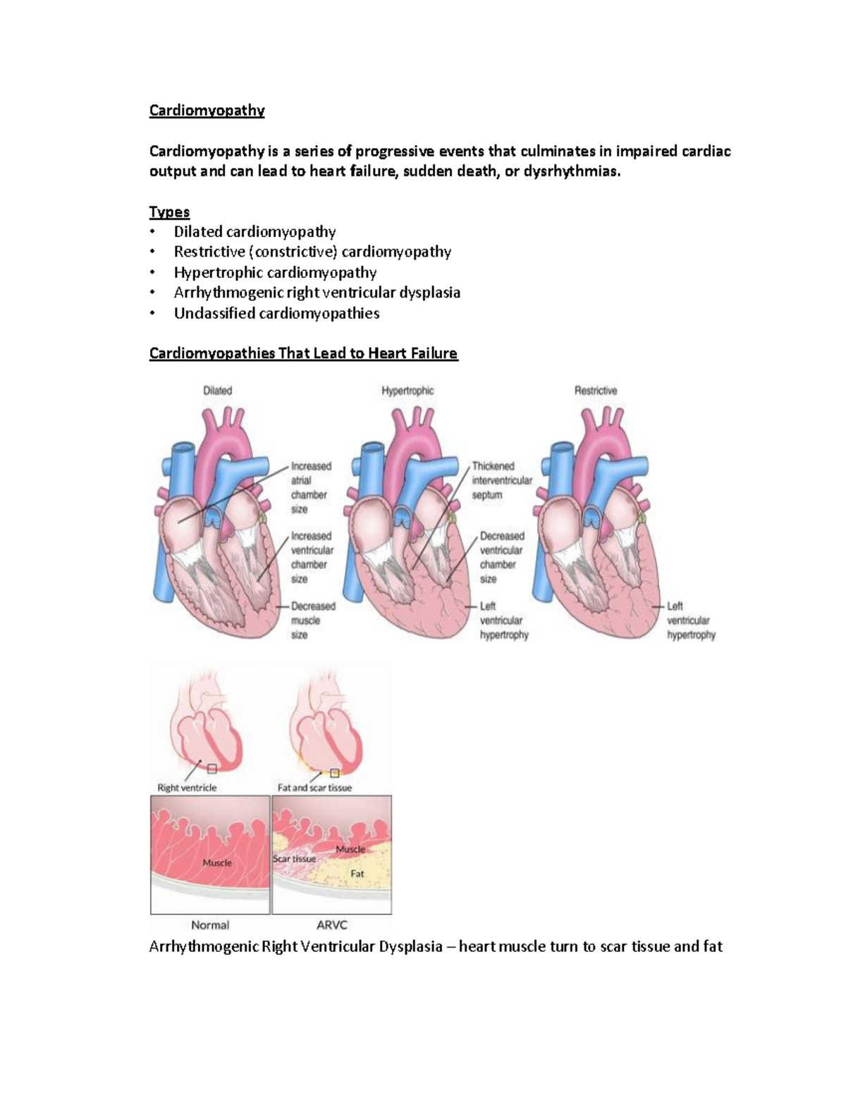 case study of cardiomyopathy