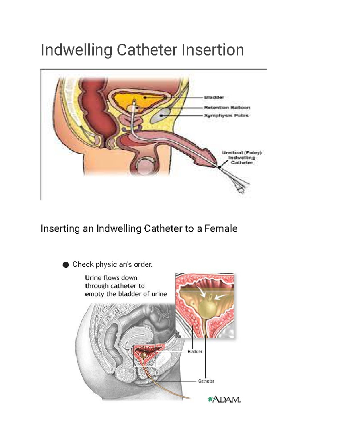 Indwelling Catheter Insertion Indwelling Catheter Insertion Inserting