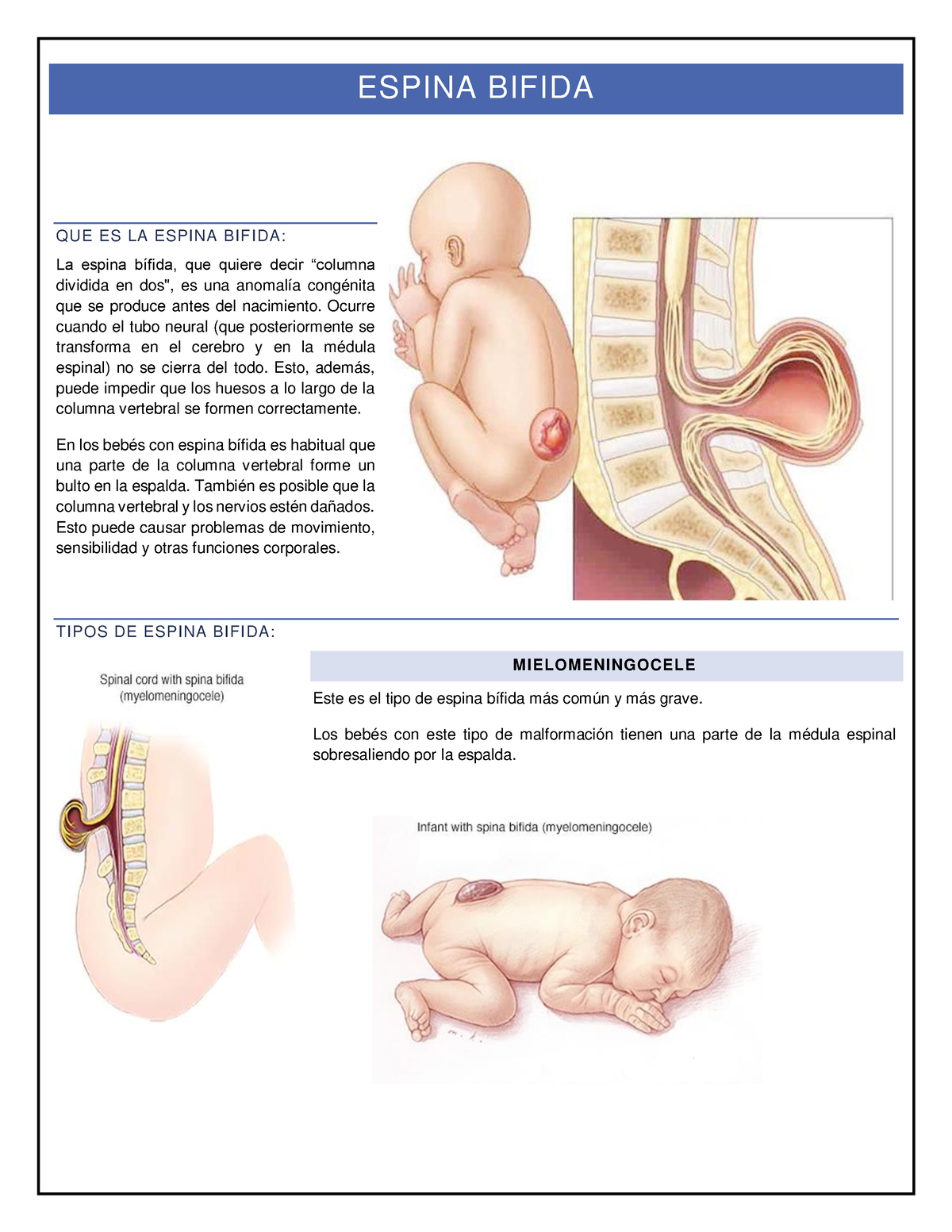 Espina Bifida Espina Bifida Que Es La Espina Bif Ida La Espina Bífida Que Quiere Decir 2963