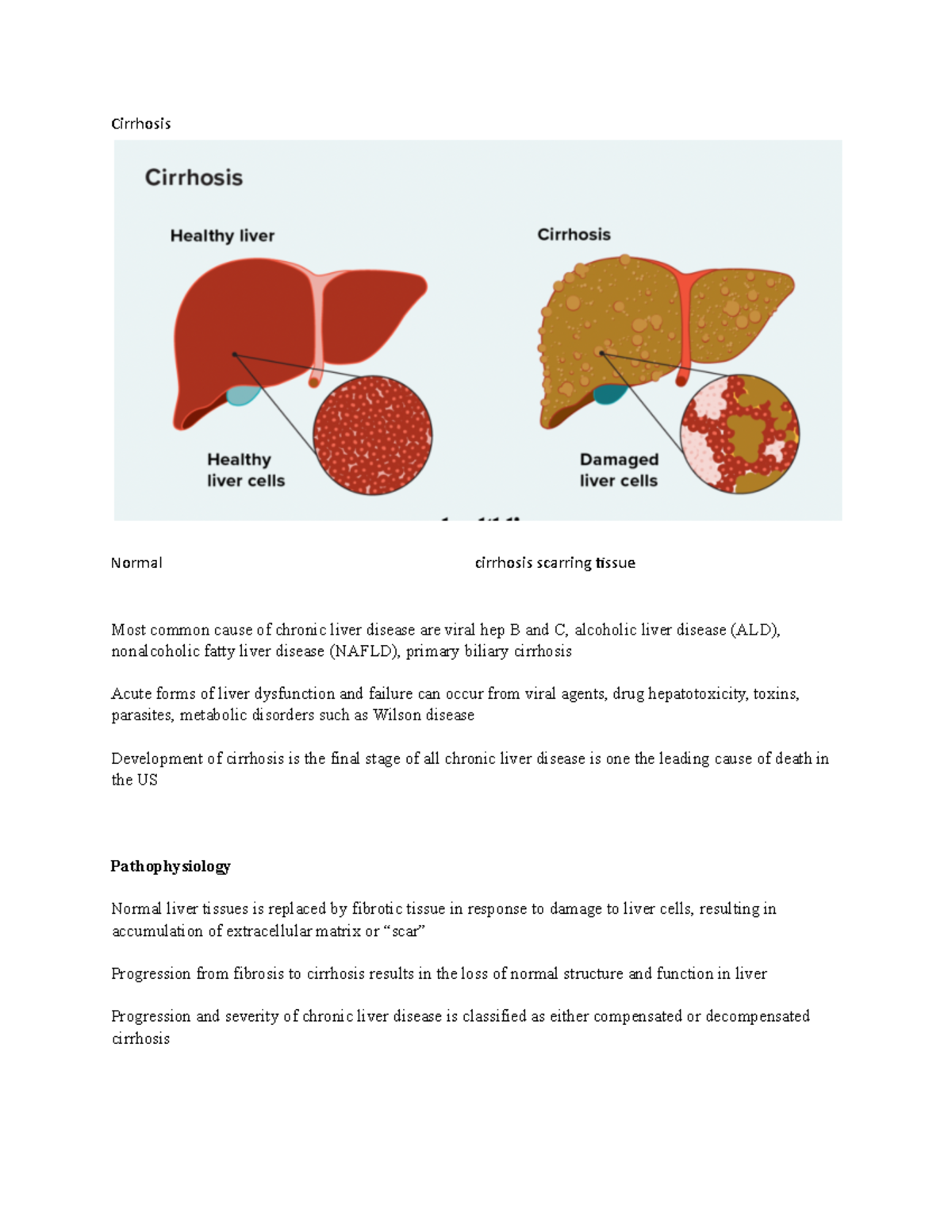Cirrhosis - Cirrhosis Normal cirrhosis scarring /ssue Most common cause ...