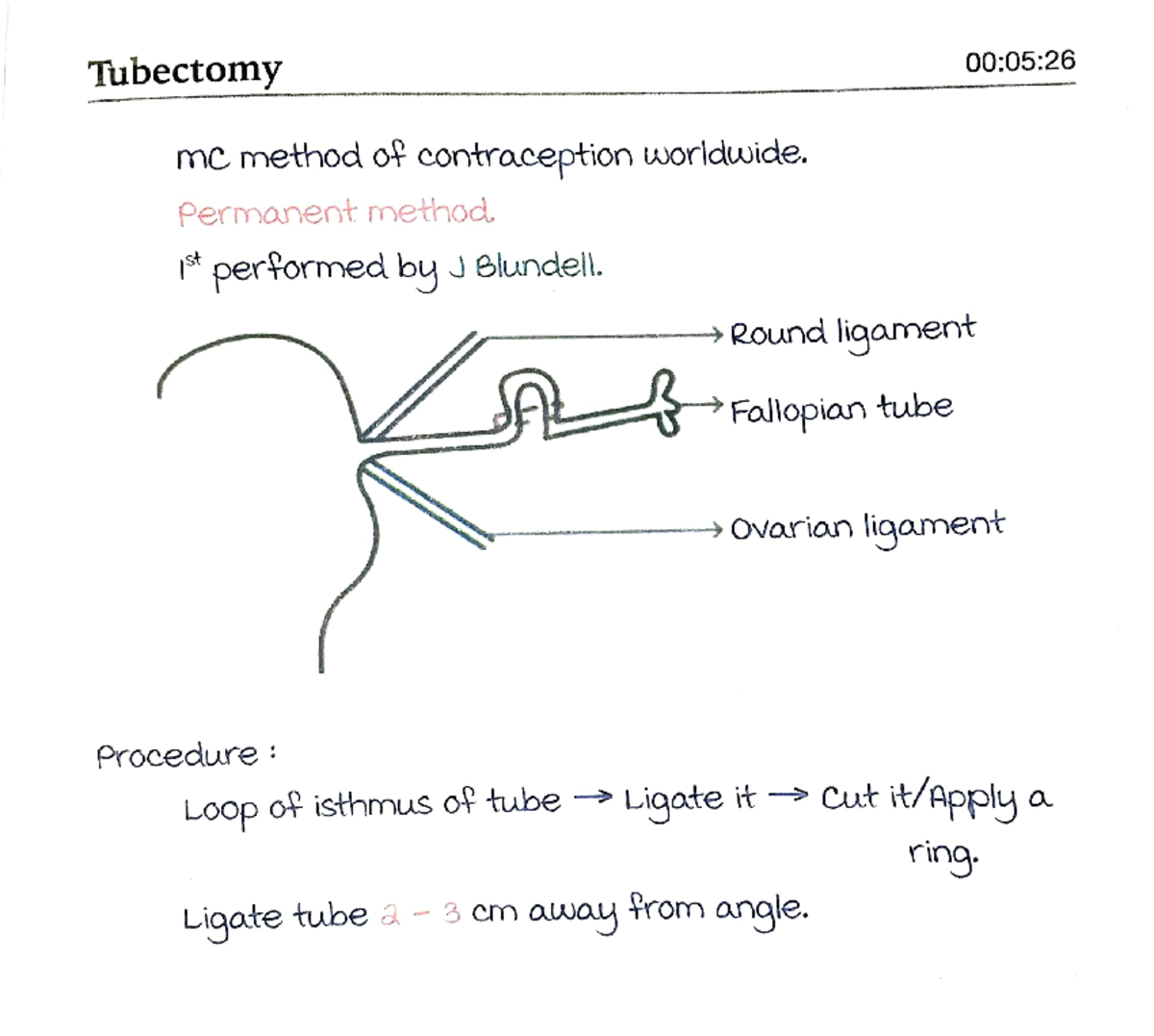 Contraception, surgical methods - Tubectomy mG mefuod o~ c.on-rro__c ...