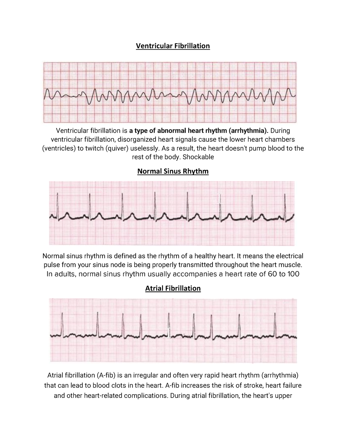 Heart Rhythms Ventricular Fibrillation Ventricular fibrillation is a