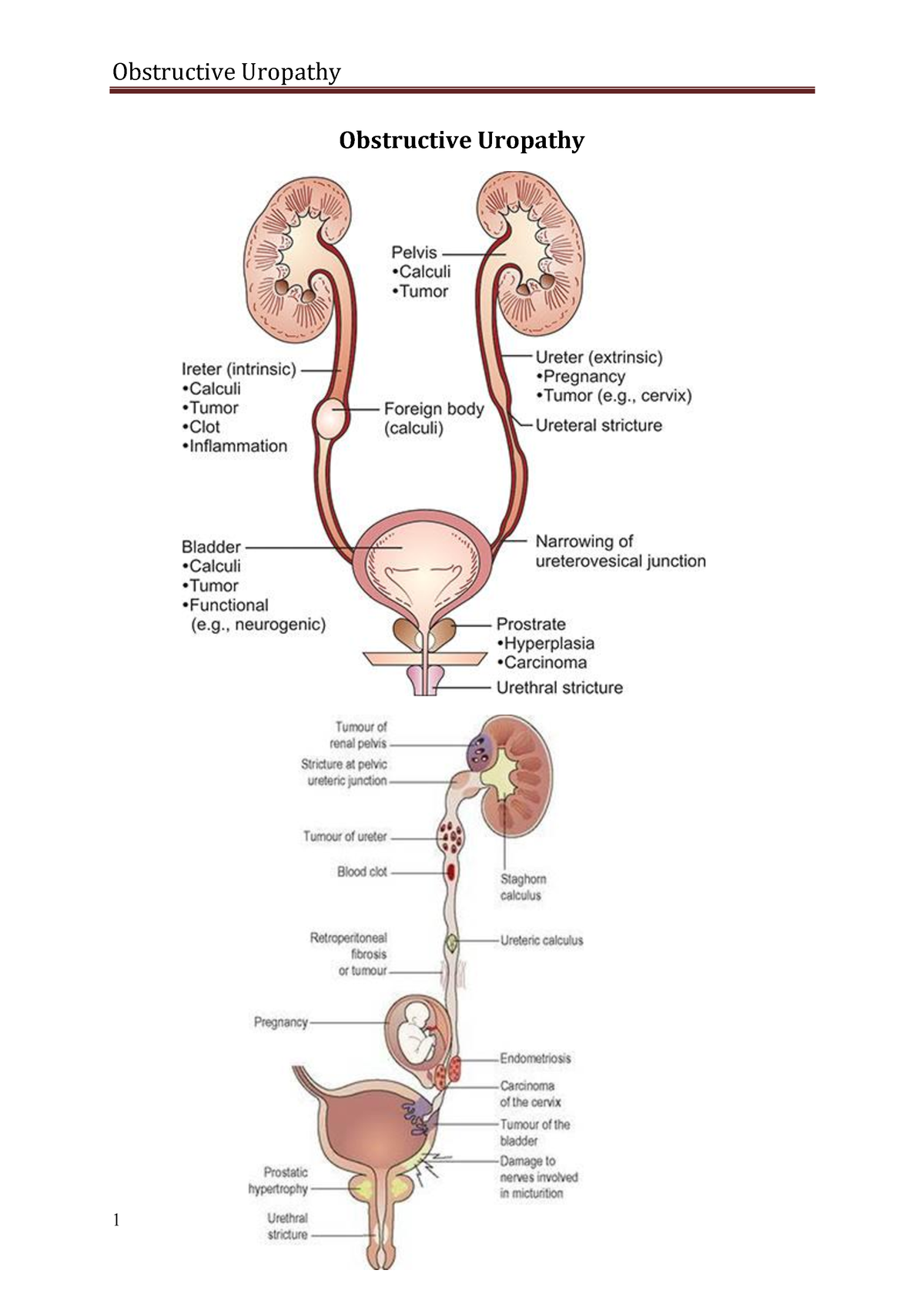 urosurgery-obstructive-uropathy-obstructive-uropathy-definition