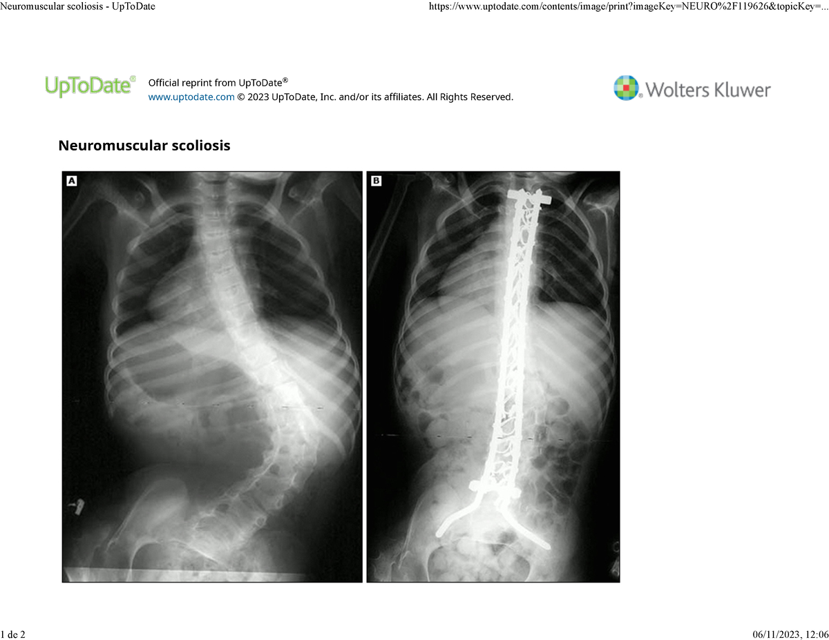 neuromuscular-scoliosis-up-to-date-231106-121001-official-reprint