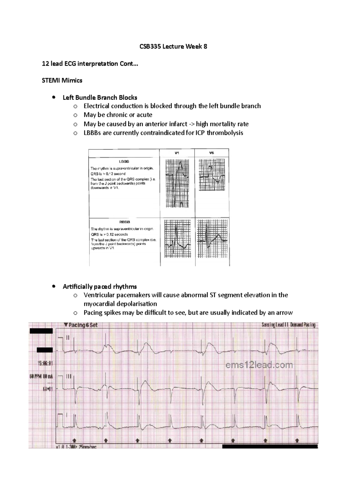 CSB335 - Acute Coronary Syndromes - CSB335 Lecture Week 8 12 lead ECG ...