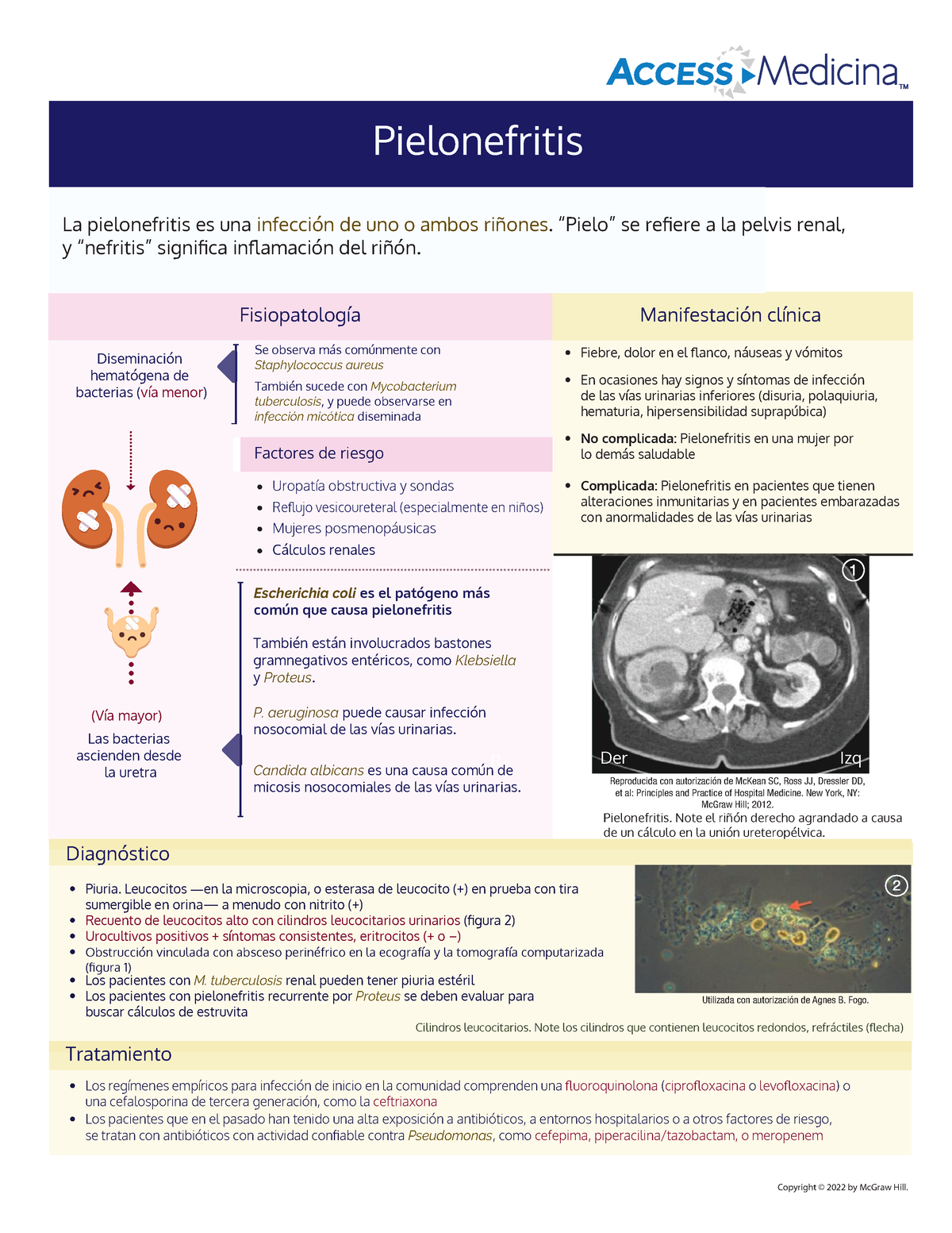 Infografía Pielonefritis - Copyright © 2022 By McGraw Hill. Fiebre ...