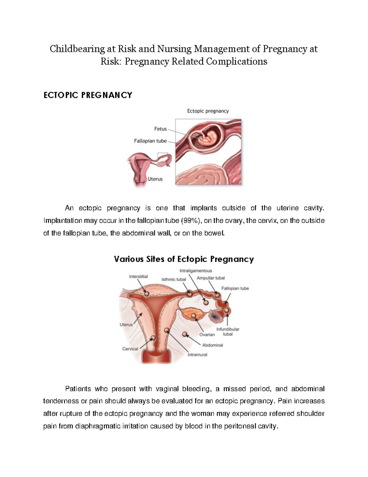 Ectopic Pregnancy - Childbearing At Risk And Nursing Management Of ...