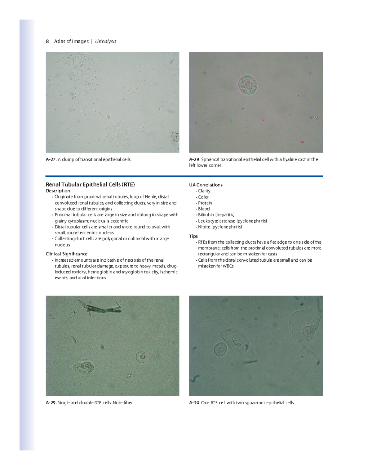 Analysis Of Urine Notes 7 8 Atlas Of Images Urinalysis A 27 A Clump Of Transitional 