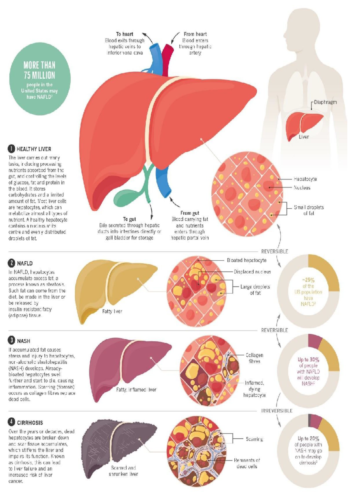 Lecture 12 - Nafld Progression Poster - XN5103 - Studocu