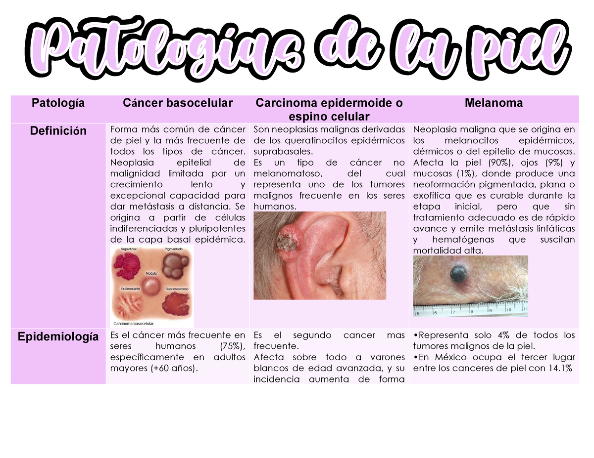 C Ncer De Piel C Ncer De Piel Patolog A Cncer Basocelular Carcinoma Epidermoide O Espino