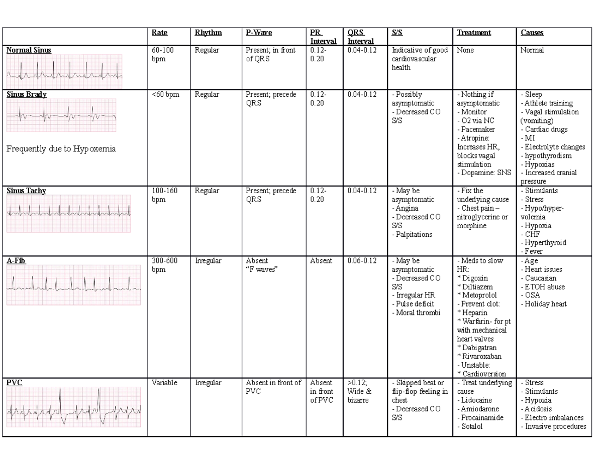 Dysrhythmias Chart - Rate Rhythm P-Wave PR Interval QRS Interval S/S ...