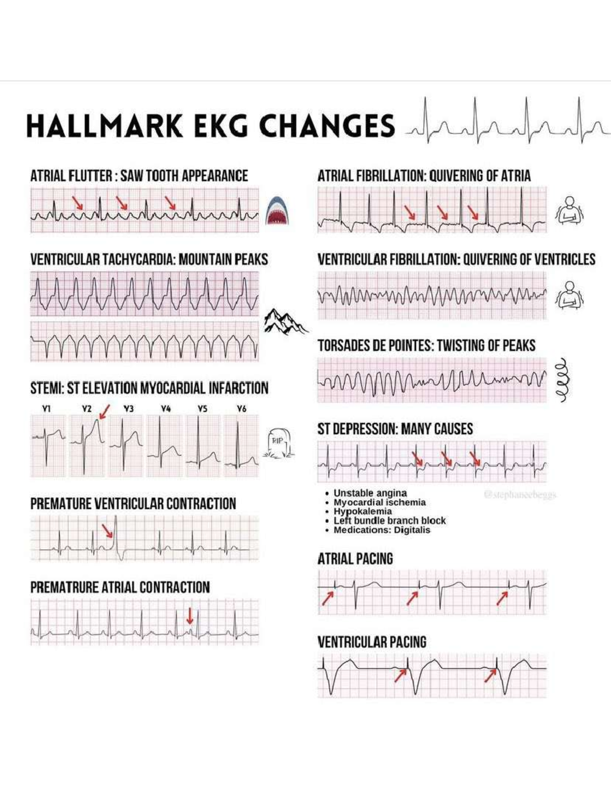 ECG Tracing - references - Medical Surgical Nursing - Studocu