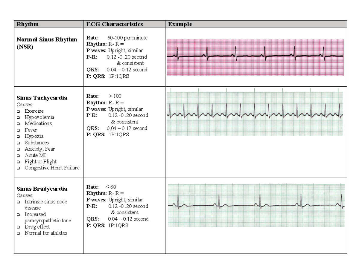 EKG Cheat Sheet - Normal Sinus Rhythm (NSR) Rate: 60-100 per minute ...