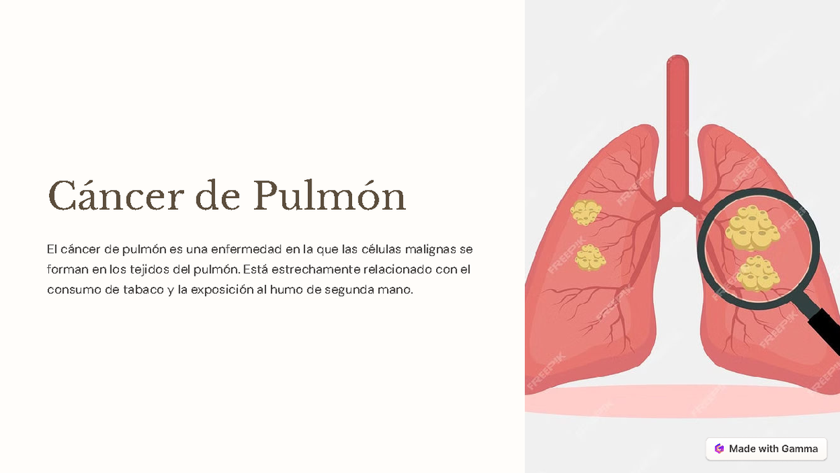 Cancer-de-Pulmon - Cáncer de Pulmón El cáncer de pulmón es una