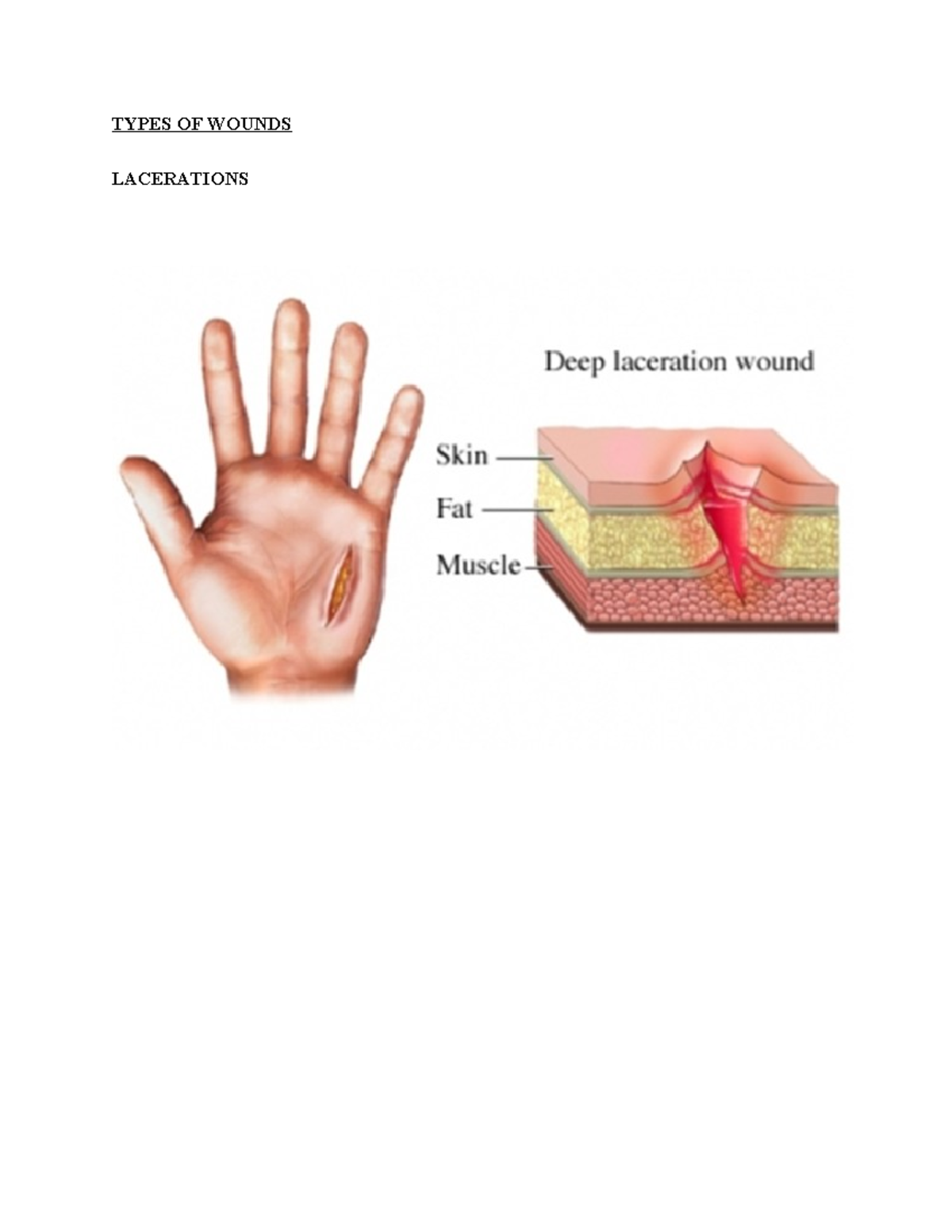 Types OF Wounds - anatomy - TYPES OF WOUNDS LACERATIONS PUNCTURE WOUND ...