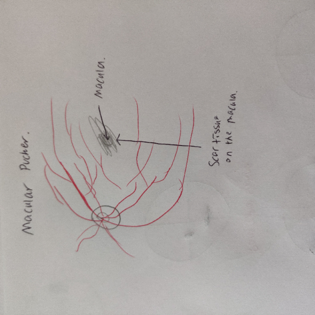 Macular scar tissue hand drawn diagram - M3B525791 - Studocu