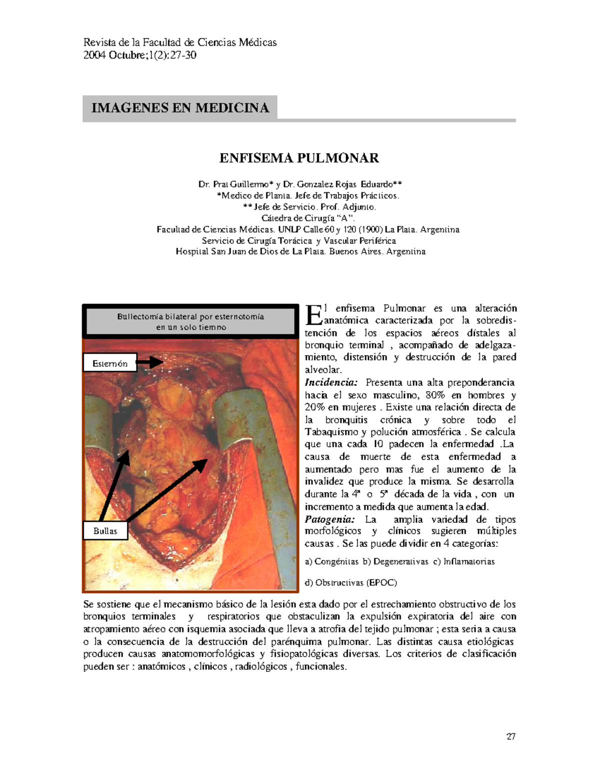 Enfisema pulmonar - algo - 2004 Octubre;1(2):27- ENFISEMA PULMONAR Dr
