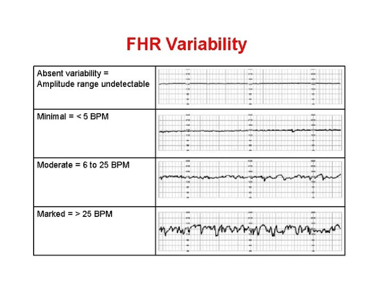 Fetal Monitor Basics - DON'T REALLY KNOW MUCH - FHR Variability Absent ...