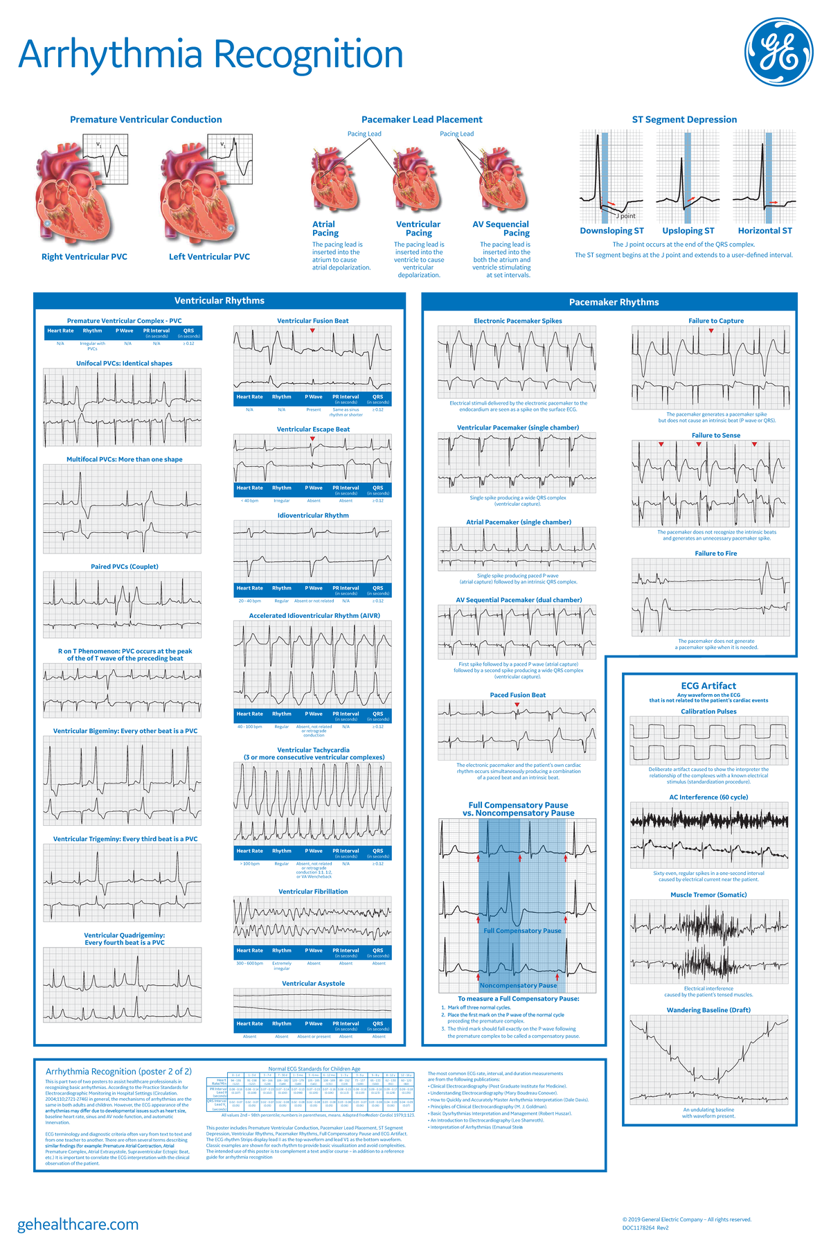 Arrhythmia Recognition Poster Part 2 - Right Ventricular PVC Left ...