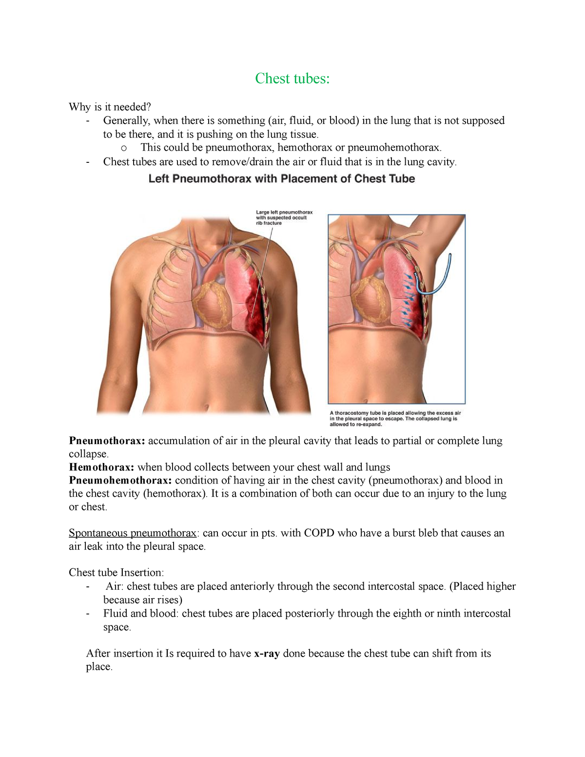 hemothorax chest tube