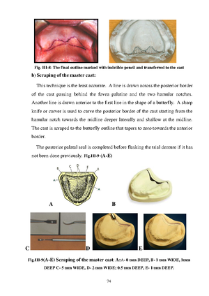 Complete denture technology 13 - 3 – The Ala-tragus Line ...