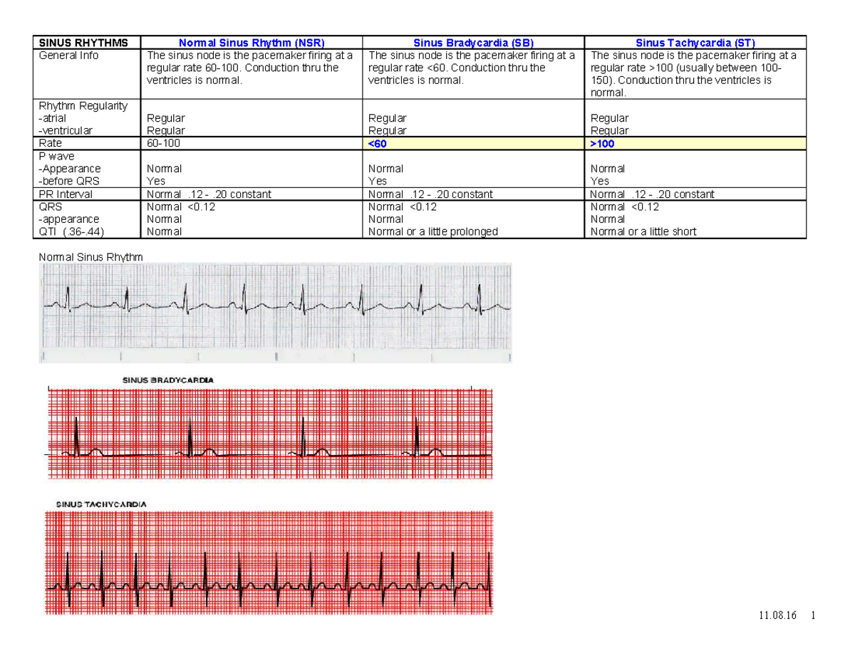 188769 2023090706252243 898704146 PDF - SINUS RHYTHMS Normal Sinus ...