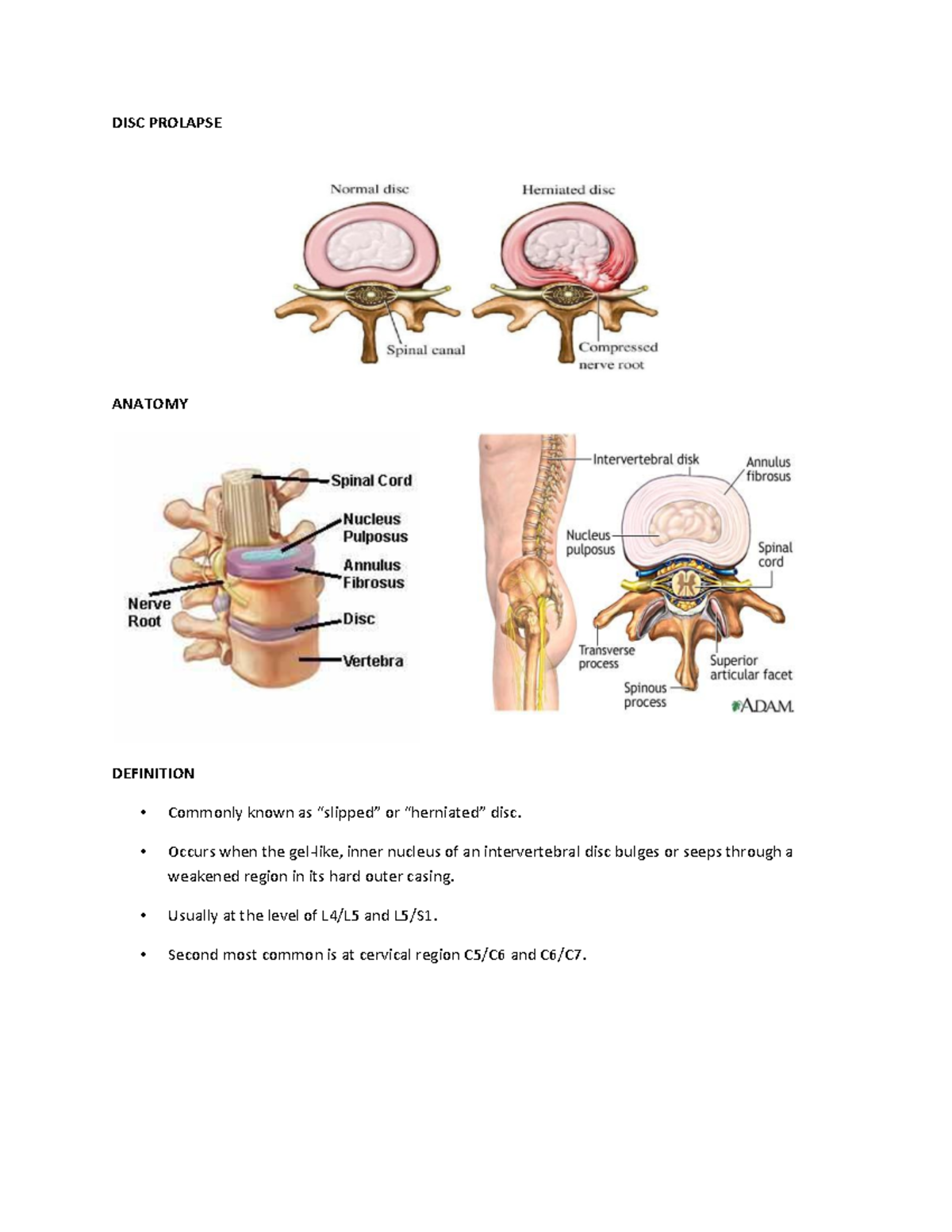 Disc Prolapse - orthopedic - DISC PROLAPSE ANATOMY DEFINITION Commonly ...