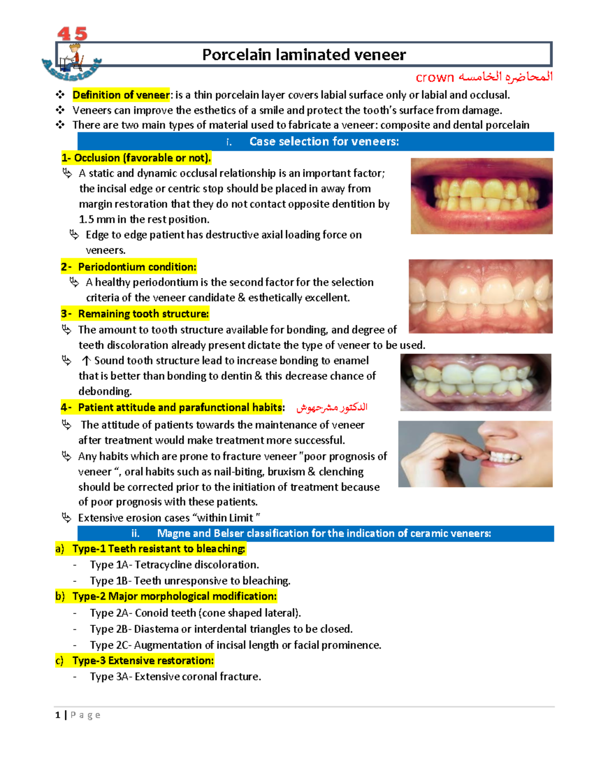 5. porcelain laminated veneers Porcelain laminated veneer crown ه