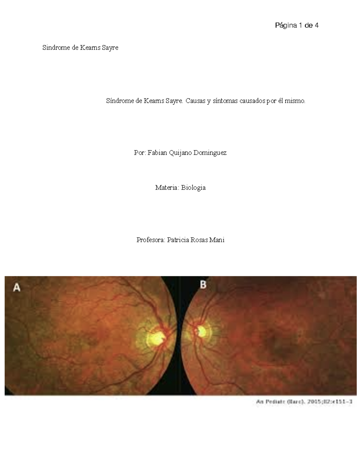 sindrome-de-kearns-sayre-final-sindrome-de-kearns-sayre-s-ndrome-de