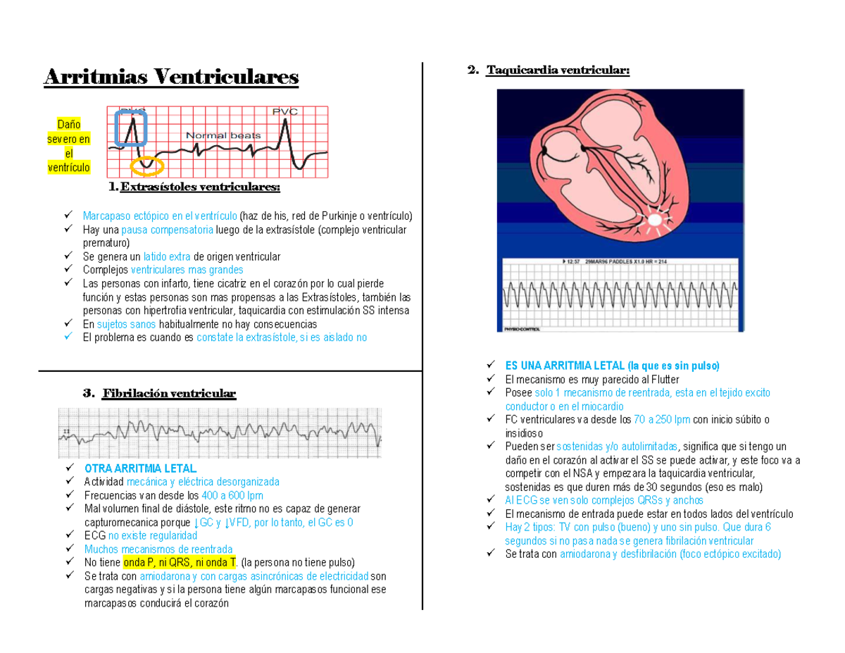 Arritmias Ventriculares - Warning: TT: Undefined Function: 32 Arritmias ...