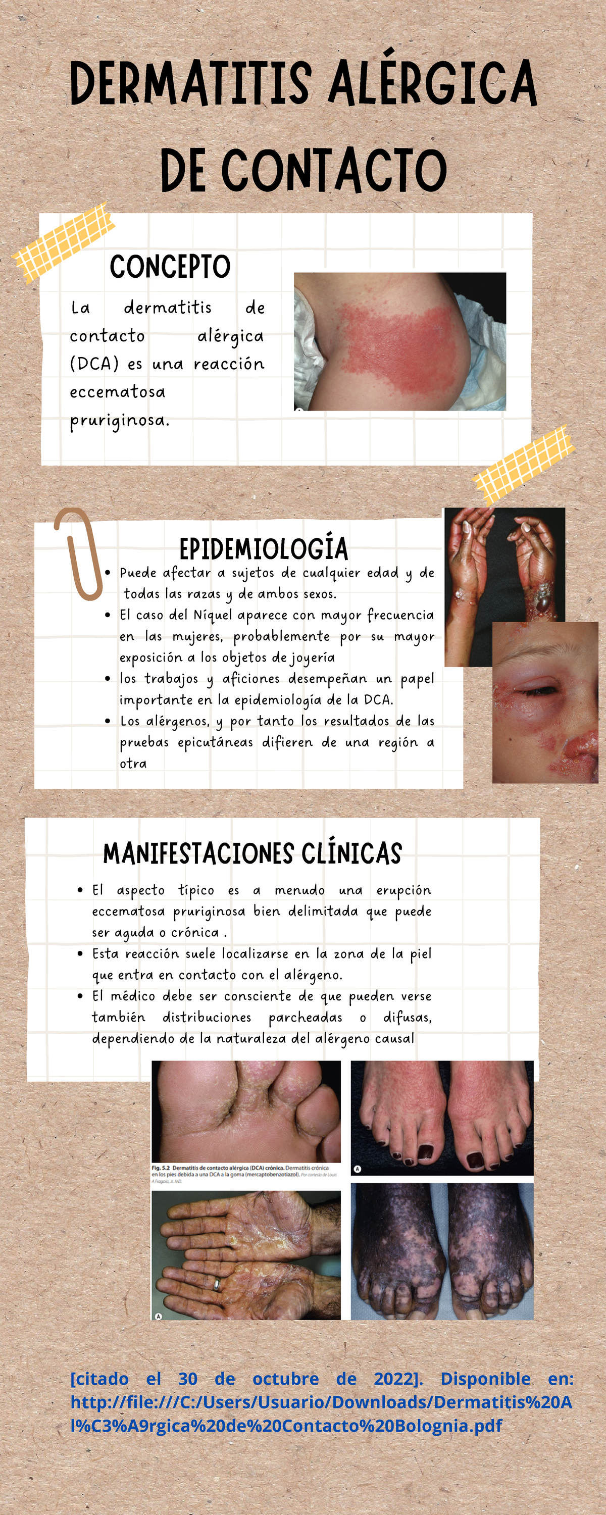 mecanismo de la dermatitis alérgica de contacto