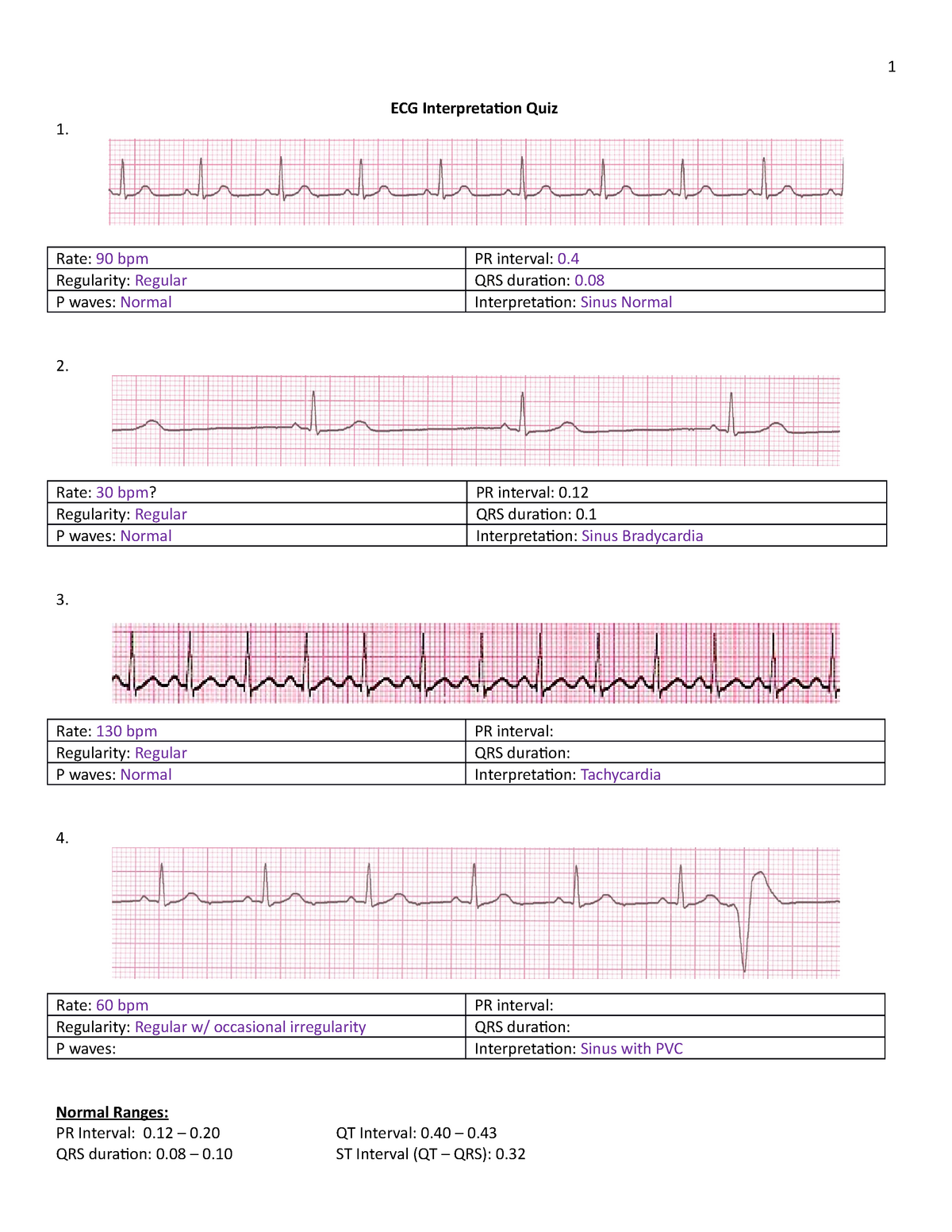 ecg-interpretation-practice-ecg-interpretation-quiz-1-rate-90-bpm