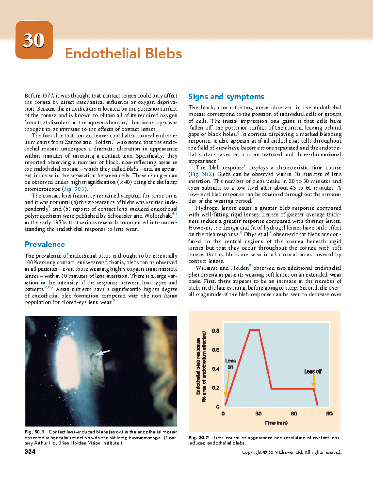 Endothelial Blebs Contact Lens Complications - 3030 Endothelial Blebs ...