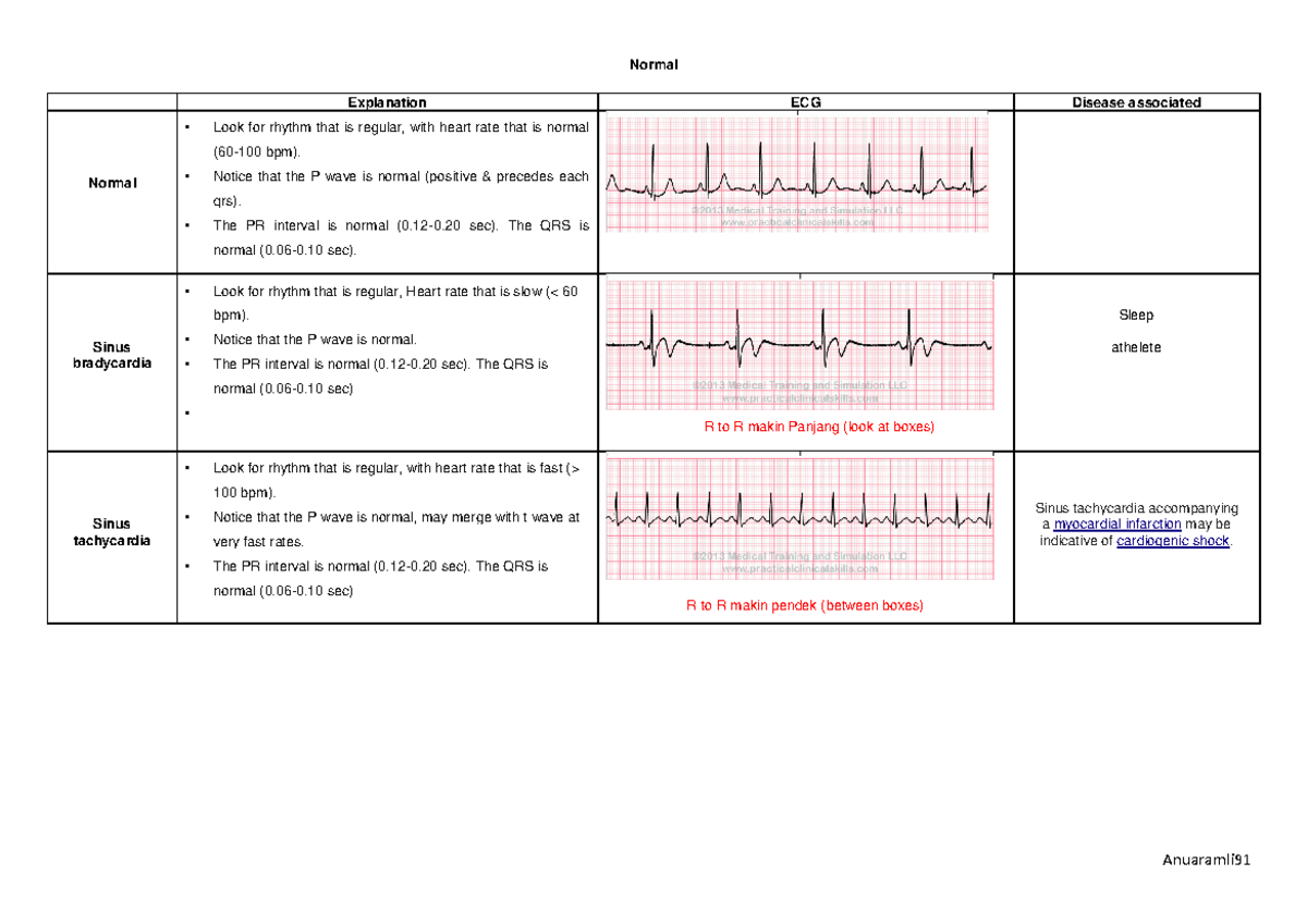 ECG Summary - Basic patterns found in exam for ECG - Warning: TT ...