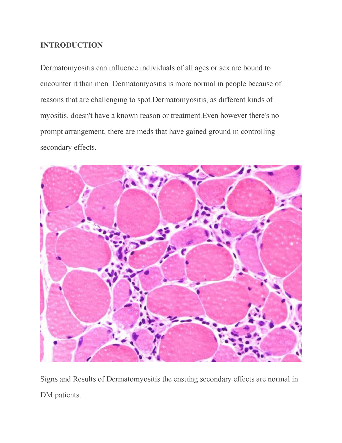 Polymyositis Introduction Dermatomyositis Can Influence Individuals Of All Ages Or Sex Are