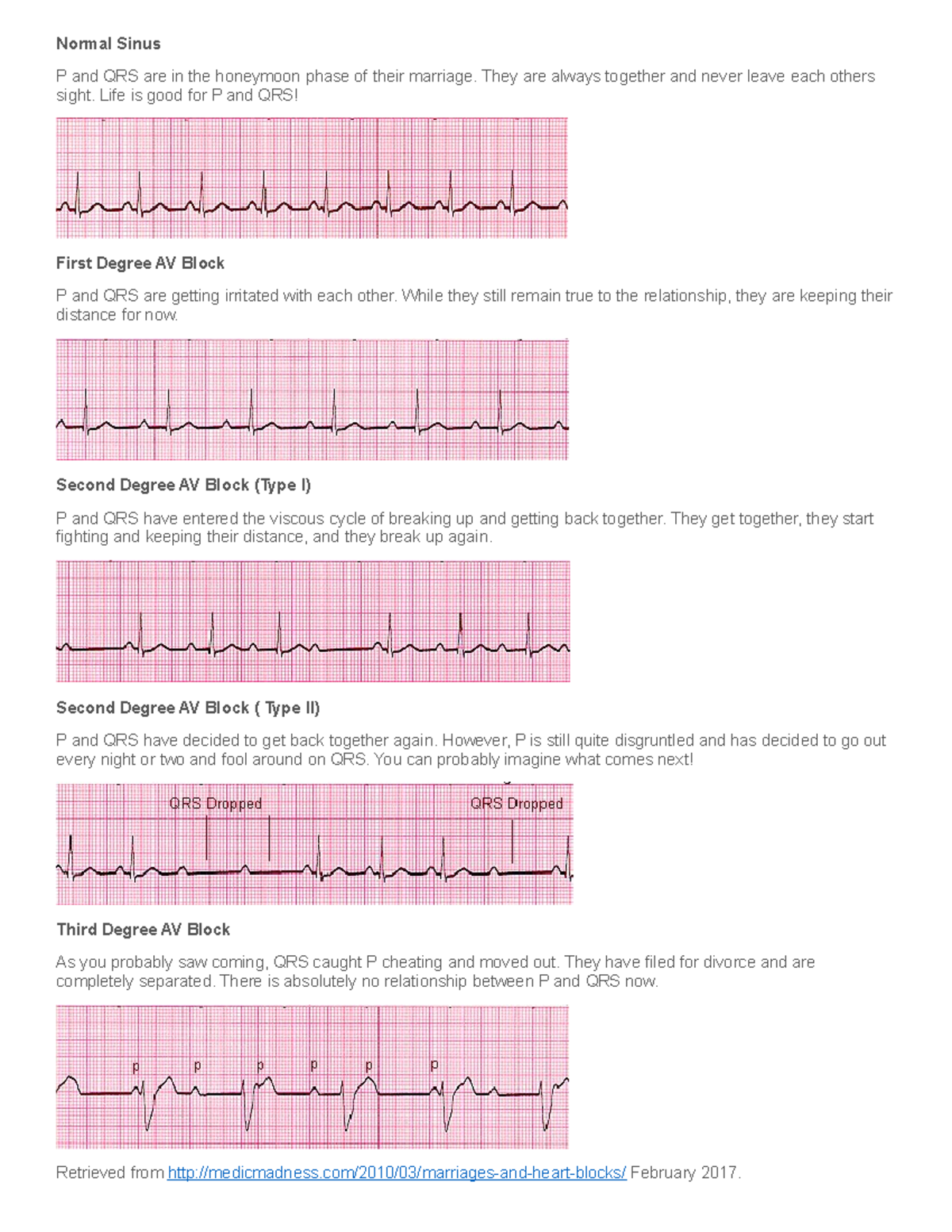 Heart Block Marriage Illustration - Normal Sinus P and QRS are in the ...