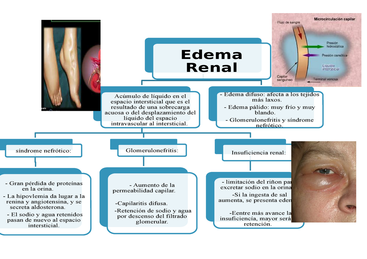 Edema En Insuficiencia Renal - Image to u