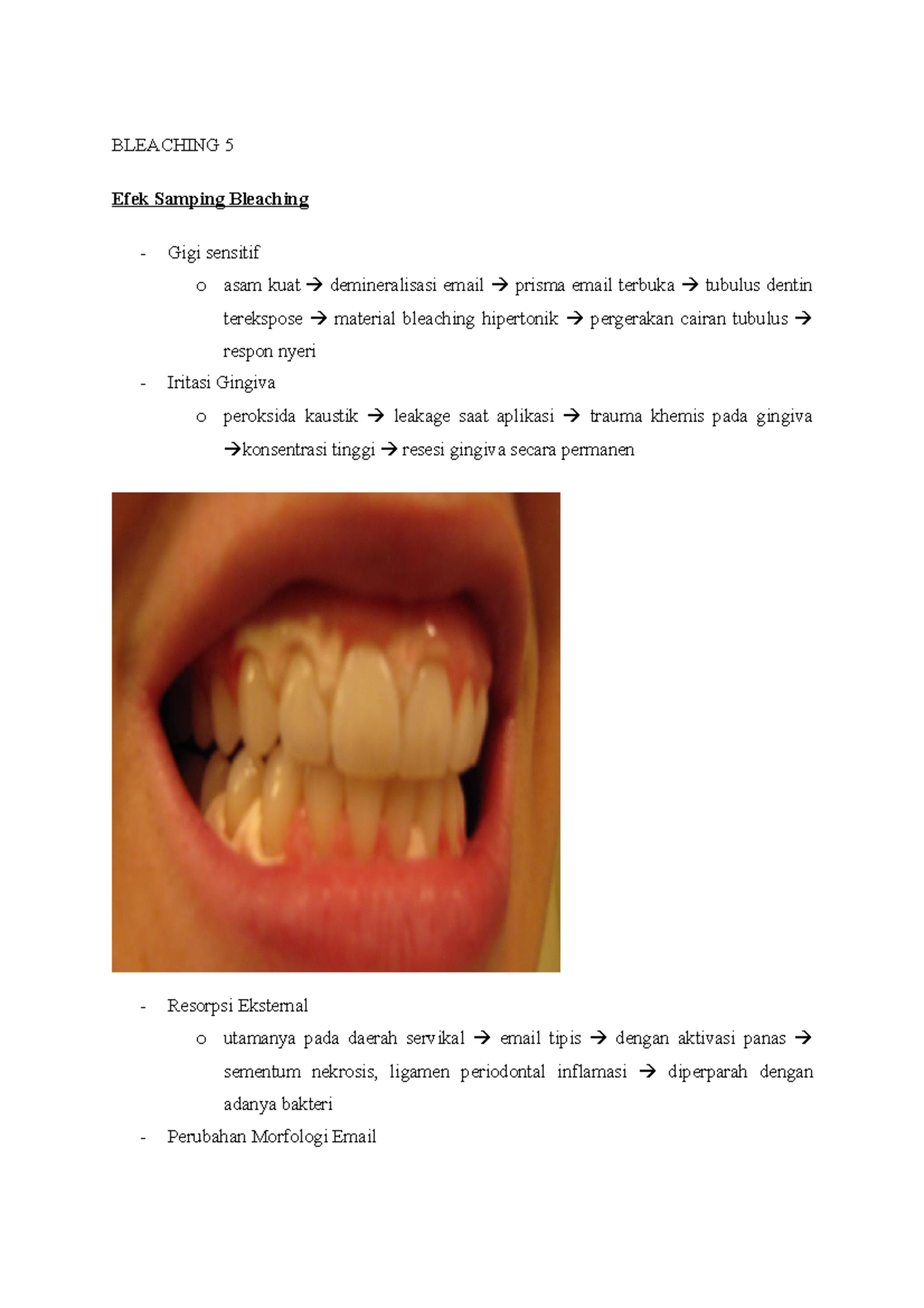 Bleaching 5 BLEACHING 5 Efek Samping Bleaching Gigi sensitif o asam