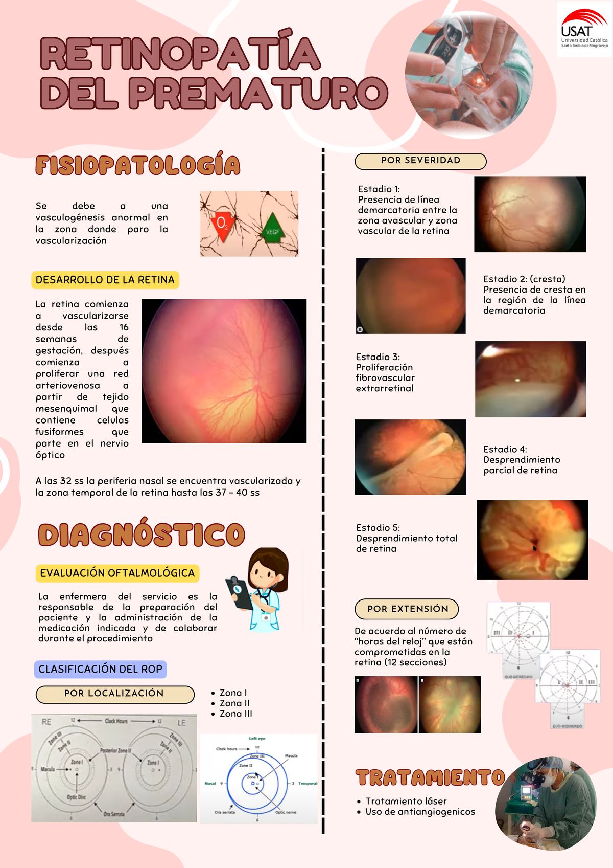 Retinopatia Del Prematuro - POR LOCALIZACIÓN RETINOPATÍA DEL PREMATURO ...