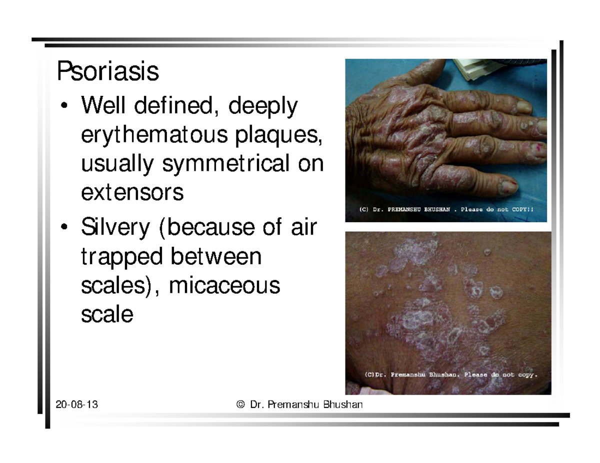Dermatology Images Dr Premanshu Psoriasis Well defined, deeply