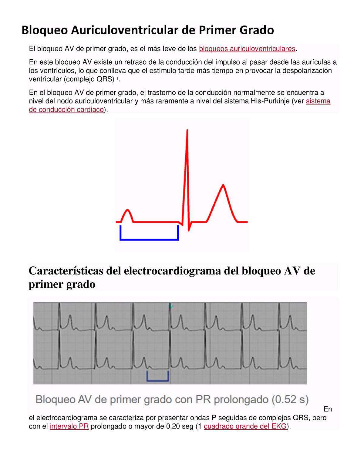 Bloqueo Auriculoventricular De Primer Grado - En Este Bloqueo AV Existe ...