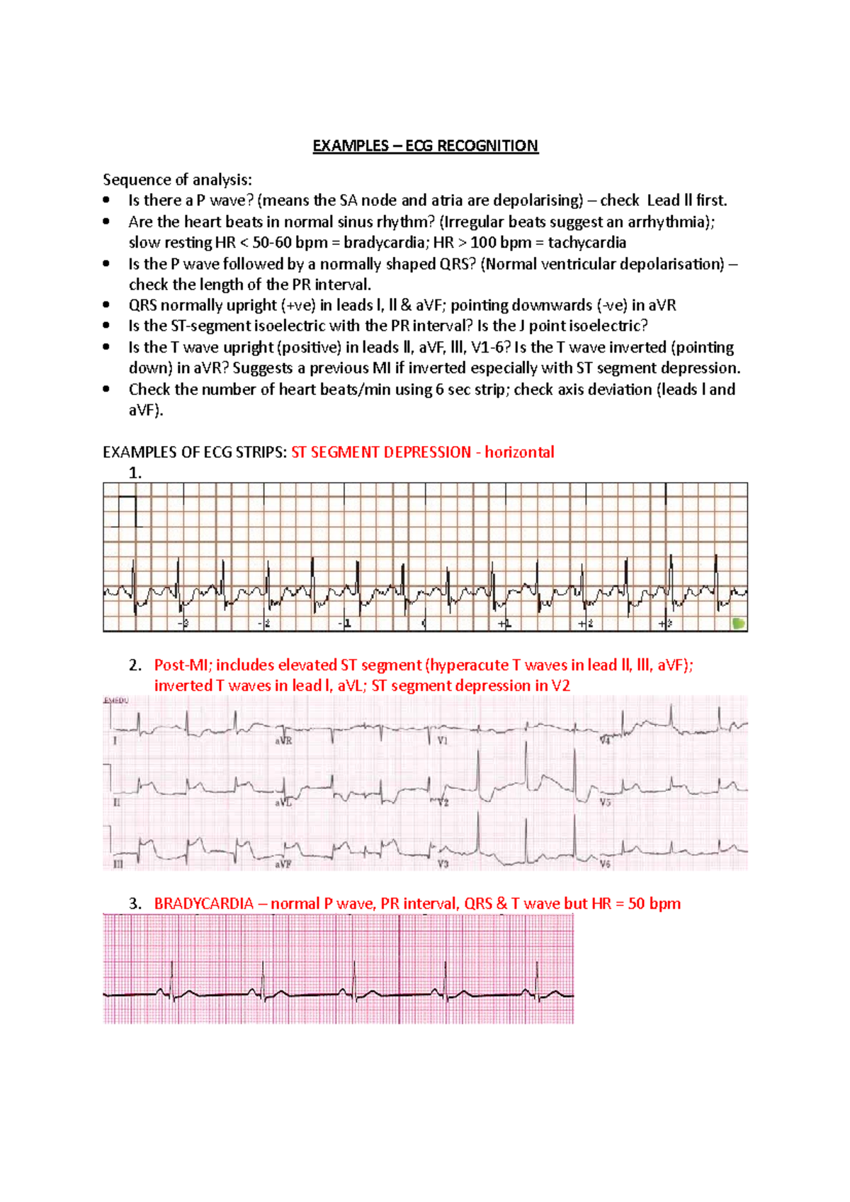 Answers ECG practice Examples - EXAMPLES ECG RECOGNITION Sequence of ...