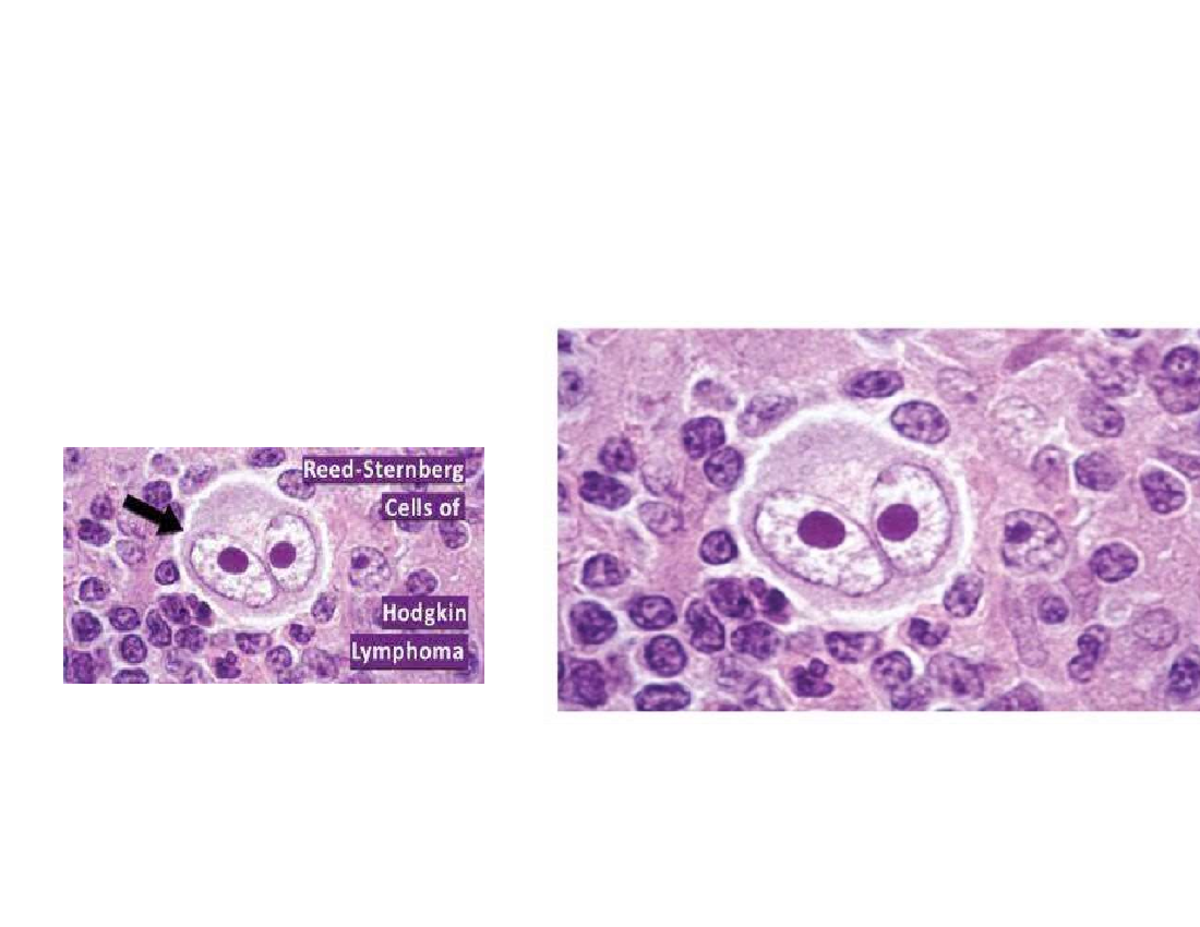 Lymphoma - Introduction • Present as enlargement of single node with ...