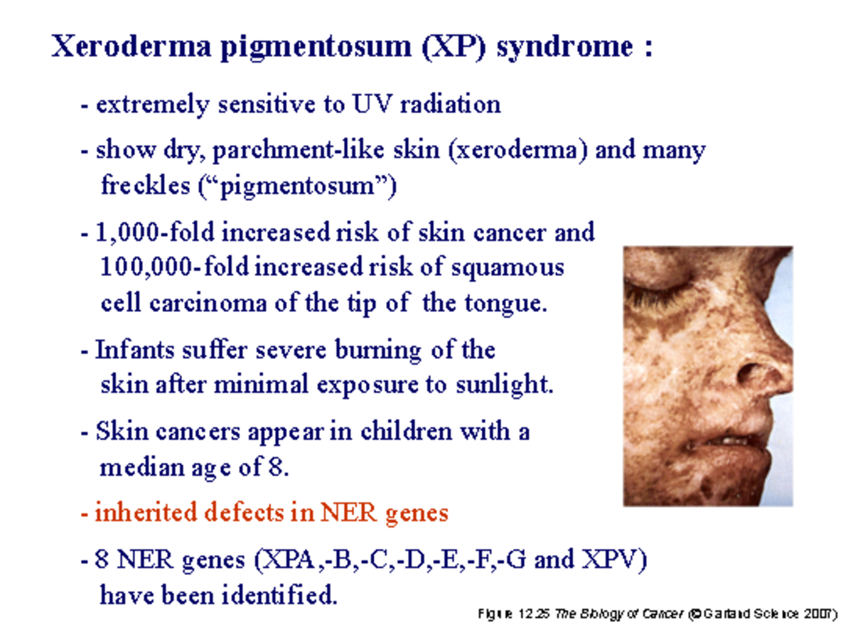 99 Noted Xeroderma Pigmentosum XP Syndrome Extremely 