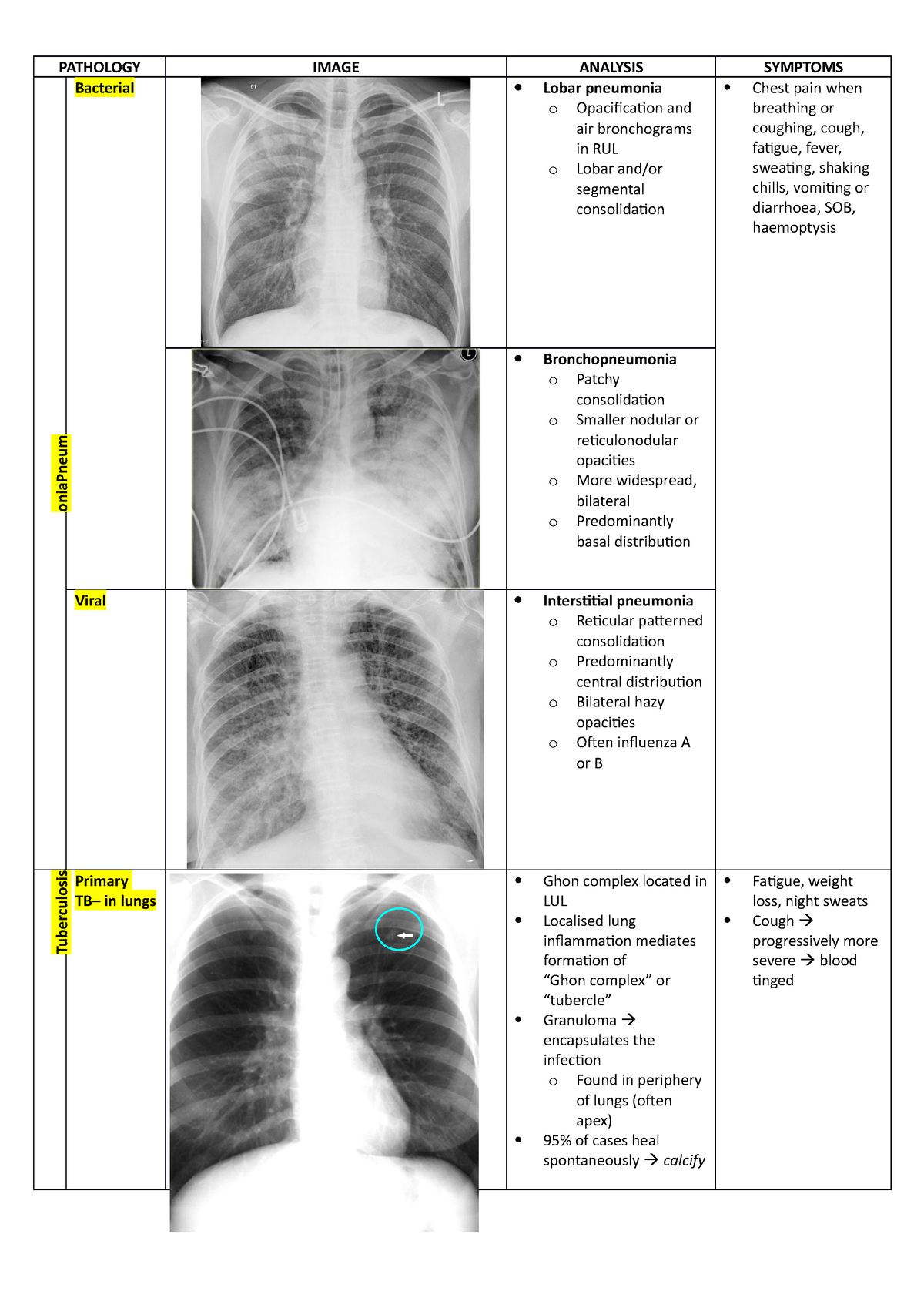 bronchopneumonia vs lobar pneumonia