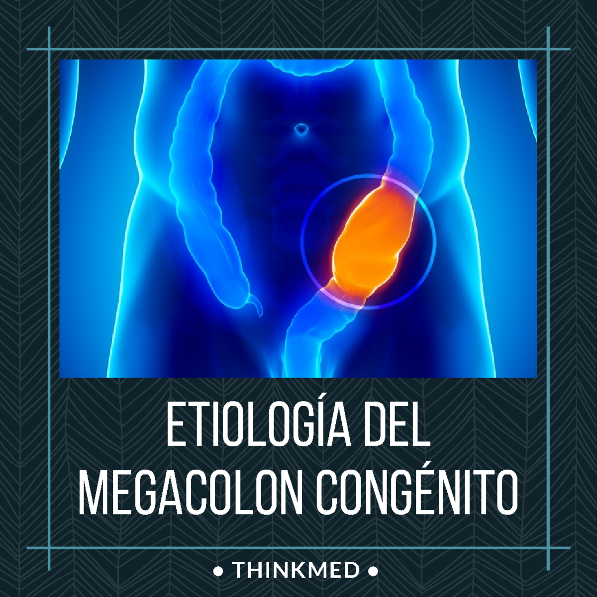 Enfermedad DE Hirschsprung ( Megacolon Congénito) - Etiología del ...