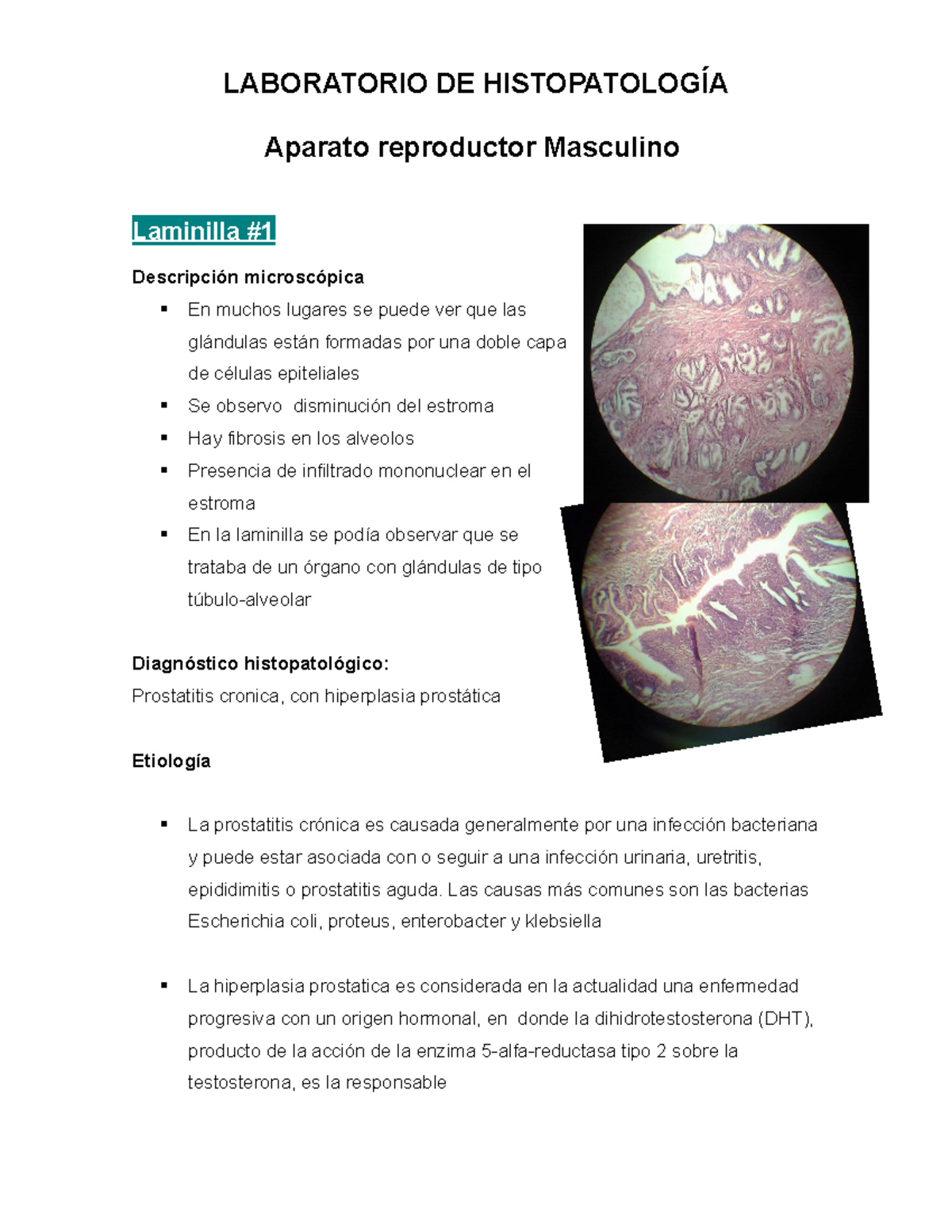 células de prostatitis y escherichia coli