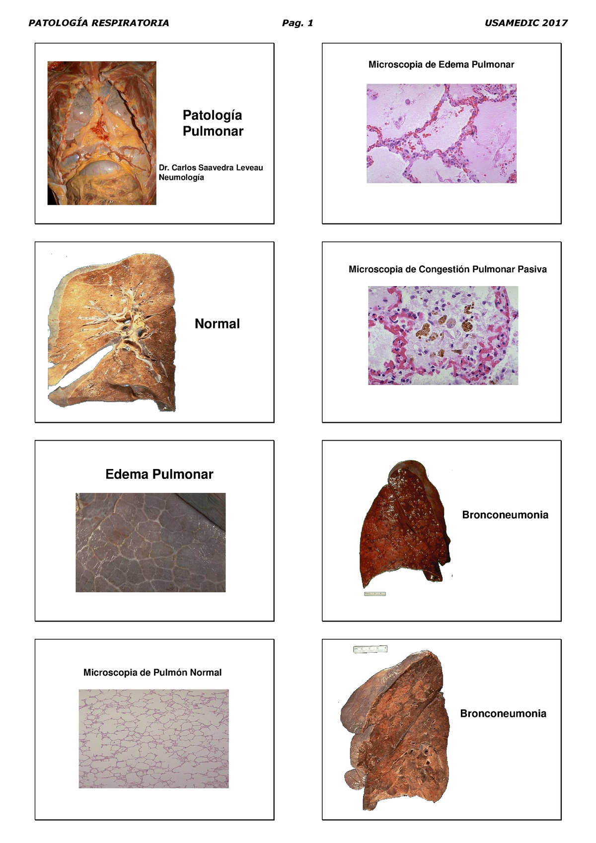 Patologia Pulmonar - Resumen - Patología Pulmonar Dr. Carlos Saavedra ...